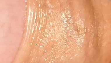 Difficult Fluid Control Due to Straight Phimosis.