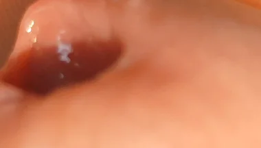 The Great Transformation of Phimosis Elastica.