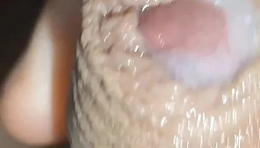 I Have the Largest Ejaculating Phimosis in the World!!