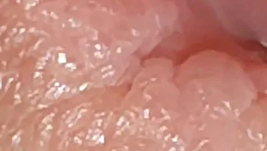 Enlargement of the Deep Urethral Hole!!