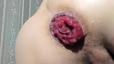 Urethral Prolapse and Anal Prolapse in One Video Xd