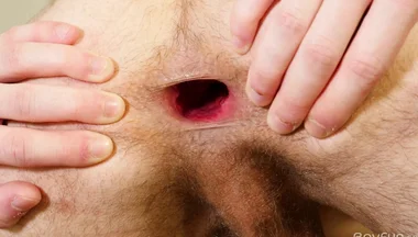 Gilliam's Gape