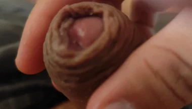 Great Phimosis Getting in the Way of the Boy's Orgasm