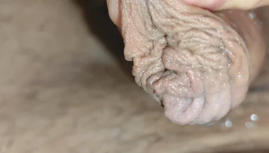 Detaching the Foreskin From the Glans Slowly.