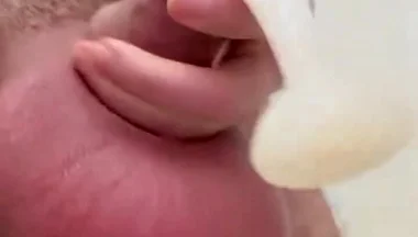 Inflated Ball Sack with Saline
