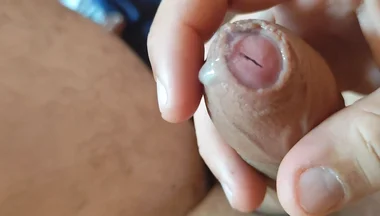 Dilation of the Corpus Cavernosum Exposes Spongy Foreskin.