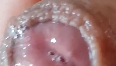 Deep Split in the Glans Produces Bubbling Liquid
