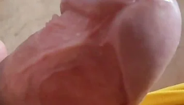 Scarred Frenulum Causes Glans Erection!