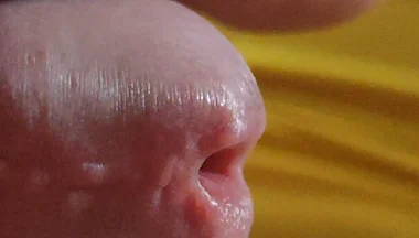 Scarred Frenulum Causes Glans Erection!