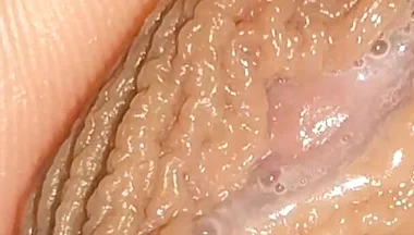 Curious Close-up of Pre-cum in Flaccid Phimosis.