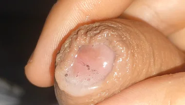 Curious Close-up of Pre-cum in Flaccid Phimosis.