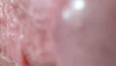 Opening the Scar of the Rough Frenulum!