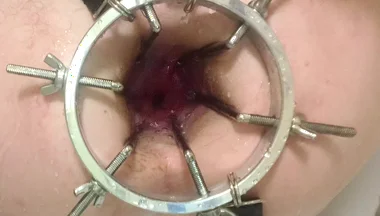 Enema, Anal Shower. Close-up View Through Anal Mirror. Anal with Water. Filling Anal with Water