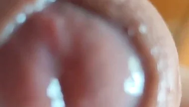 The Glans Appears Crowning Inside the Phimosis.
