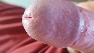 The Blossoming of Extensive Elastic Phimosis.