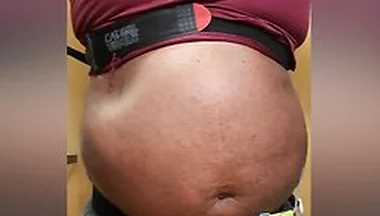 N2o Belly Inflation