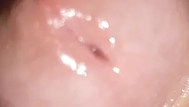 Maximum Dilation of Phimosis Cumming.
