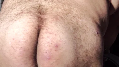 Fat Obese Butt