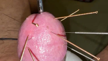 Acupuncture - Orgasm!