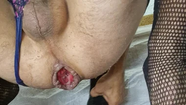 Analslutprolaps