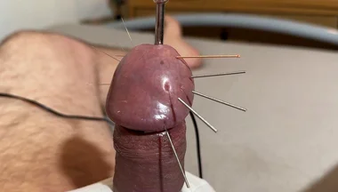 The Best Acupuncture Method!