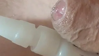 Homemade Self-adhesive Venous Pole Implant!!!