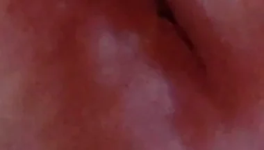 Dilation of the Glans Eye Has a Pleasant Surprise.