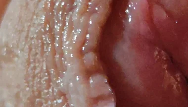 Dilation of the Glans Eye Has a Pleasant Surprise.