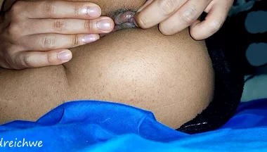 Hemorrhoids in the Ass