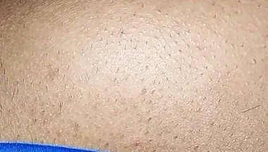 Hemorrhoids in the Ass