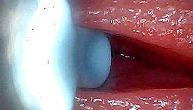 I Couldn’t Believe What Happens Inside the Penis as Sperm Passes Through (endoscopic Footage)