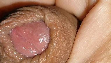 Boy with Large Anal Phimosis Excited!